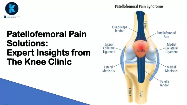 patellofemoral pain solutions expert insights from the knee clinic