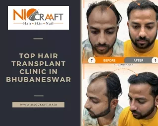 Top Hair Transplant Clinic in Bhubaneswar