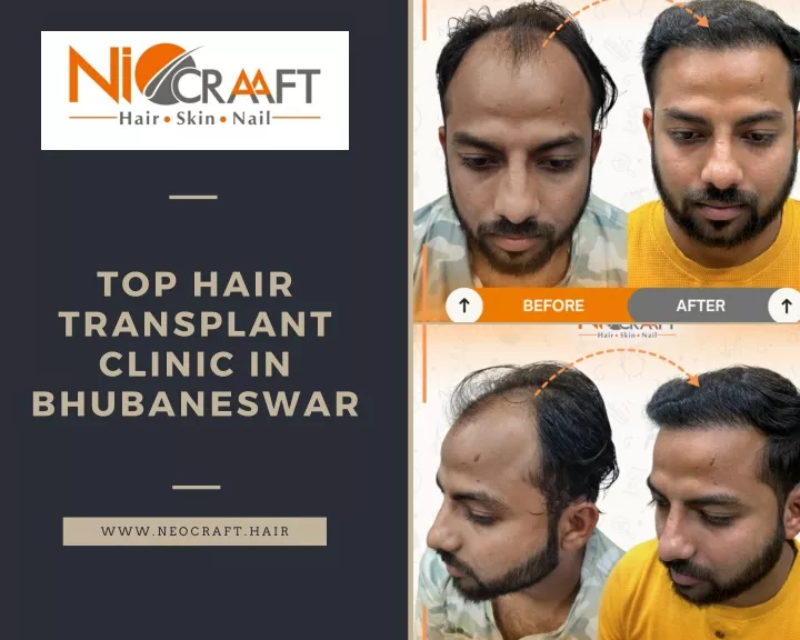 top hair transplant clinic in bhubaneswar