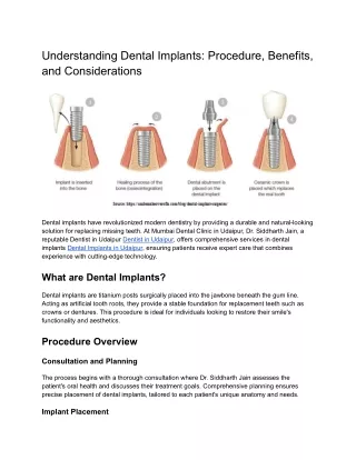 Understanding Dental Implants_ Procedure, Benefits, and Considerations