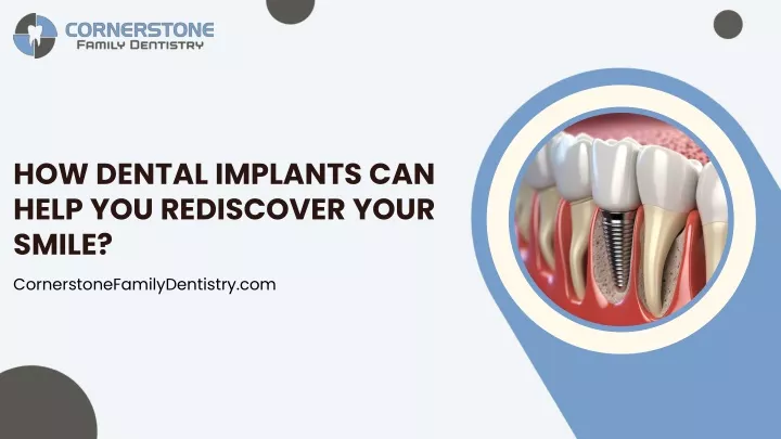 how dental implants can help you rediscover your