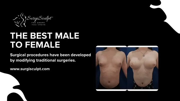 the best male to female surgical procedures have