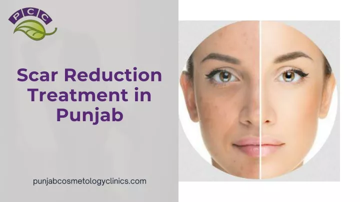 scar reduction treatment in punjab