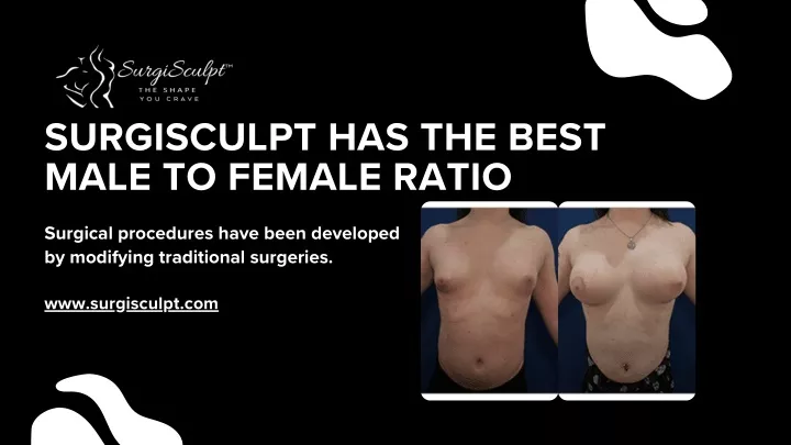 surgisculpt has the best male to female ratio