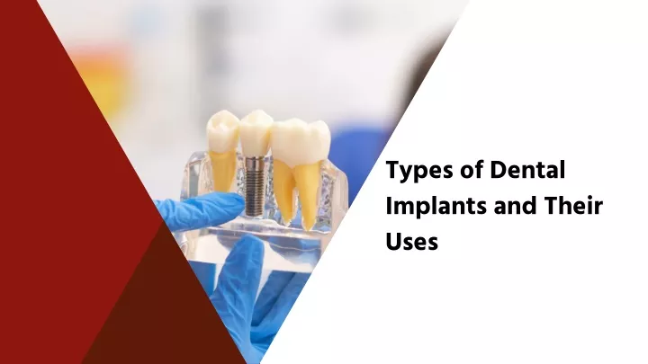 types of dental implants and their uses