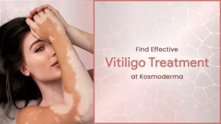 Find Effective Vitiligo Treatment at Kosmoderma