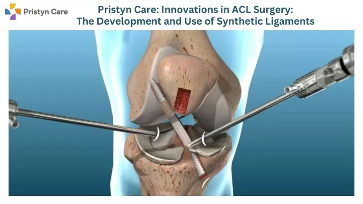 pristyn care innovations in acl surgery