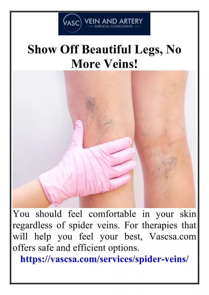 show off beautiful legs no more veins