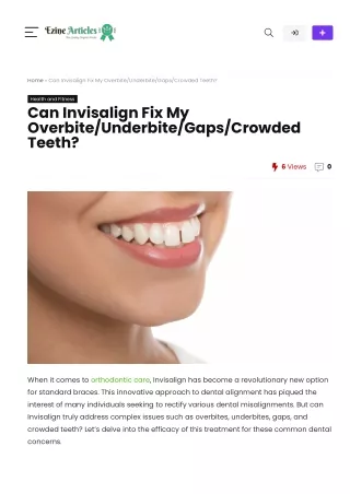 Can Invisalign Fix My OverbiteUnderbiteGapsCrowded Teeth