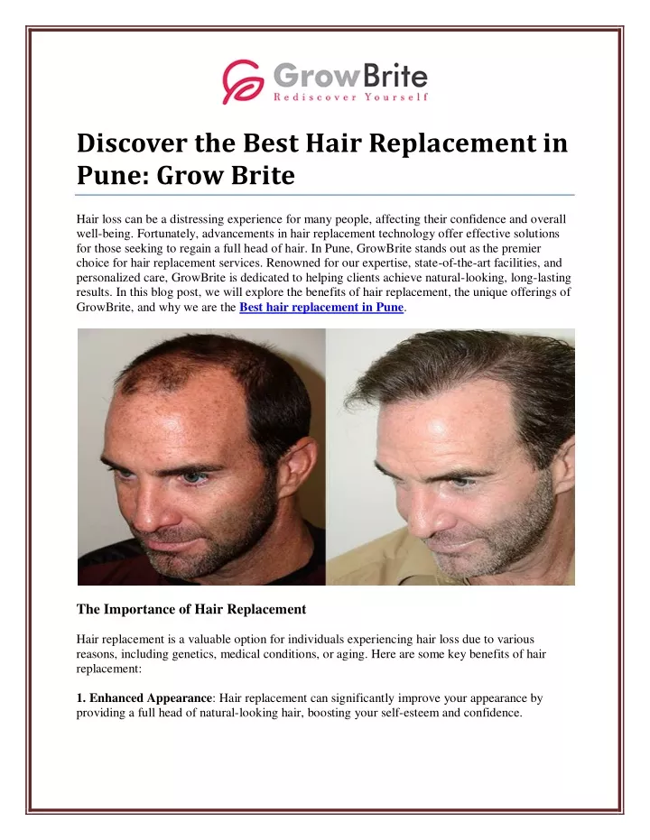 discover the best hair replacement in pune grow