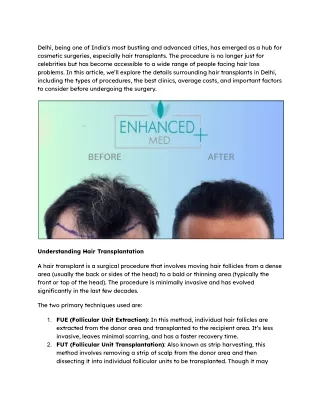Comprehensive Guide to Hair Transplant in Delhi_ Procedure, Costs, and Best Clinics
