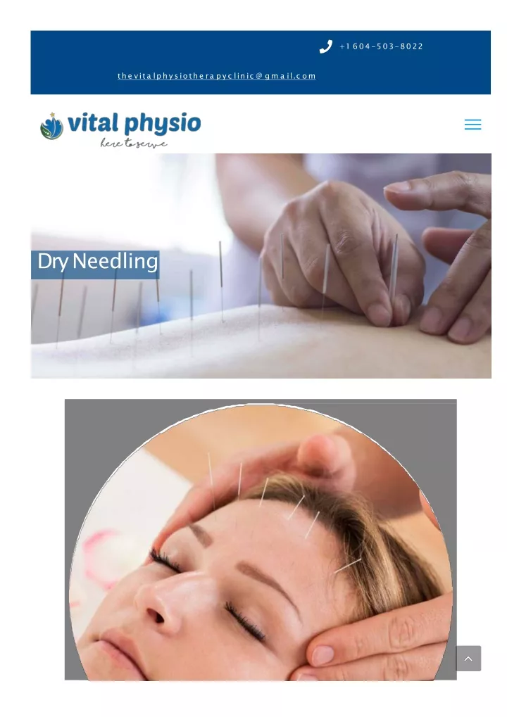 dry needling