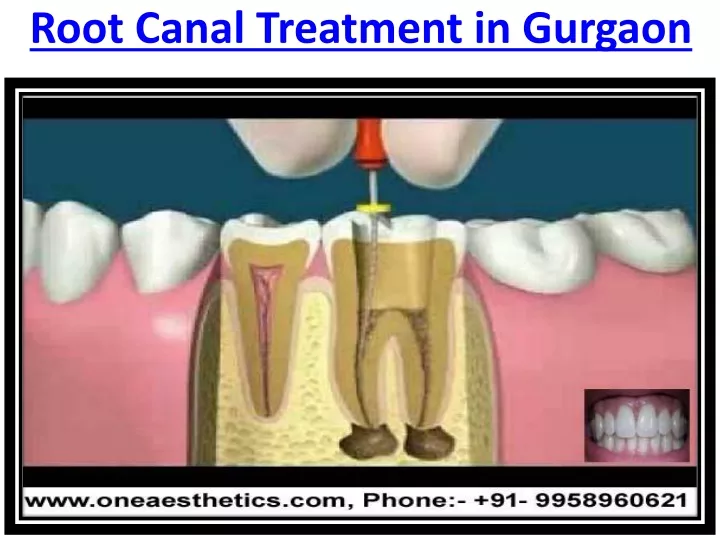 root canal treatment in gurgaon