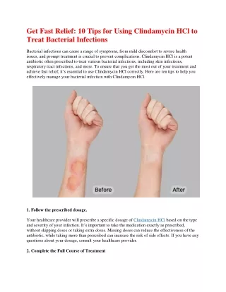 get fast relief 10 tips for using clindamycin