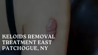 Keloids Removal Treatment East Patchogue, NY