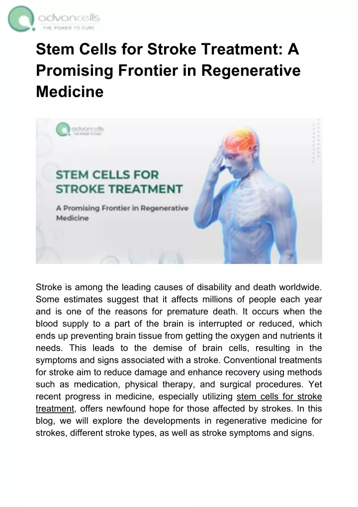 stem cells for stroke treatment a promising