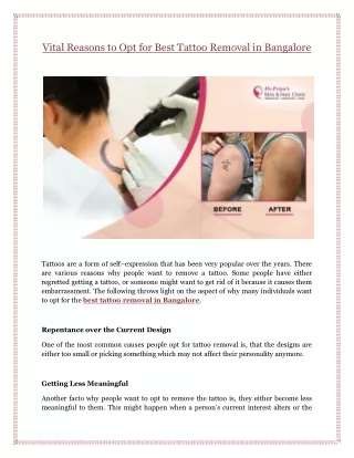 Vital Reasons to Opt for Best Tattoo Removal in Bangalore