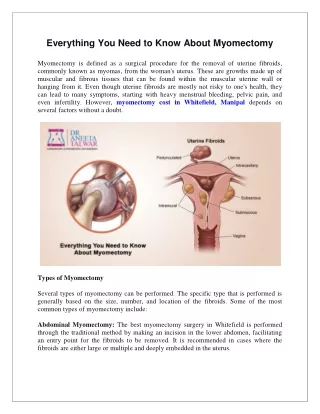 Everything You Need to Know About Myomectomy