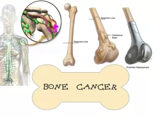 Bone Cancer: Understanding the Disease & Homeopathy Treatment Options