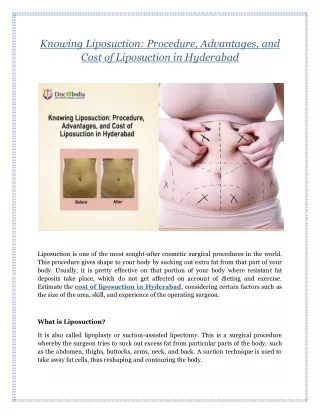 Knowing Liposuction: Procedure, Advantages, and Cost of Liposuction in Hyderabad