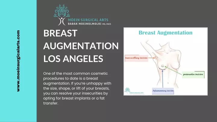 breast augmentation los angeles