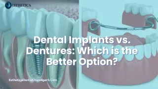 Dental Implants vs. Dentures Which is the Better Option?