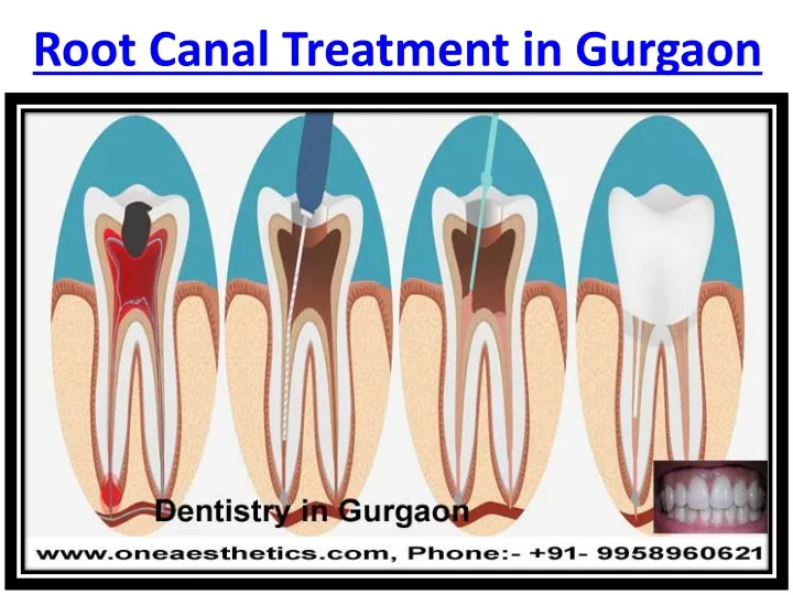 root canal treatment in gurgaon