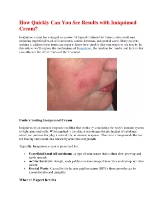 How Quickly Can You See Results with Imiquimod Cream.