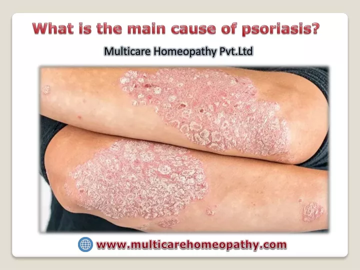 what is the main cause of psoriasis