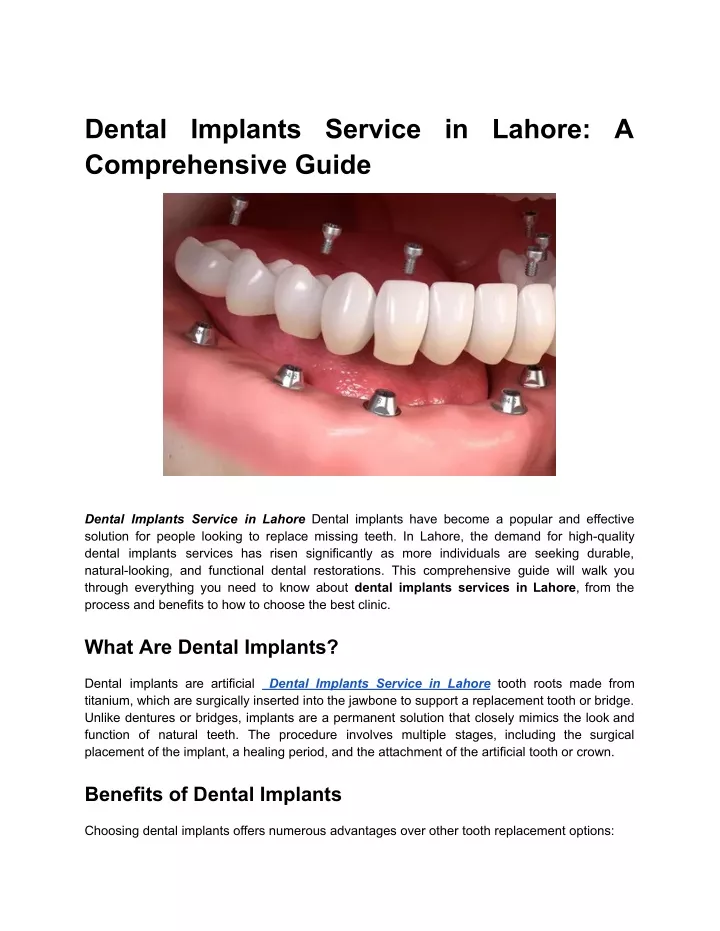 dental implants service in lahore a comprehensive