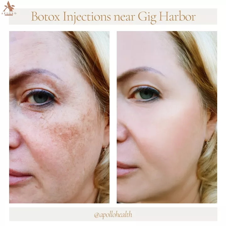 botox injections near gig harbor