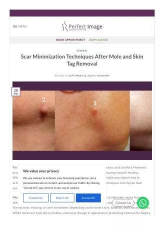 Scar Minimization Techniques After Mole and Skin Tag Removal