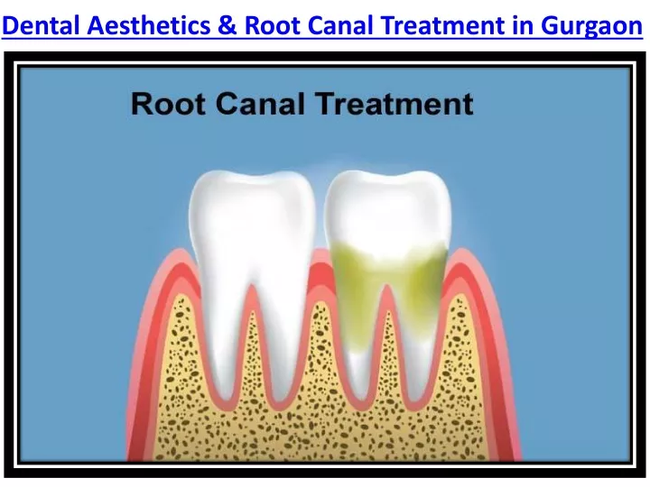 dental aesthetics root canal treatment in gurgaon