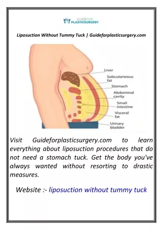 Liposuction Without Tummy Tuck  Guideforplasticsurgery.com
