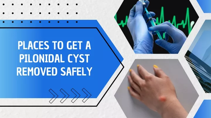 places to get a pilonidal cyst removed safely