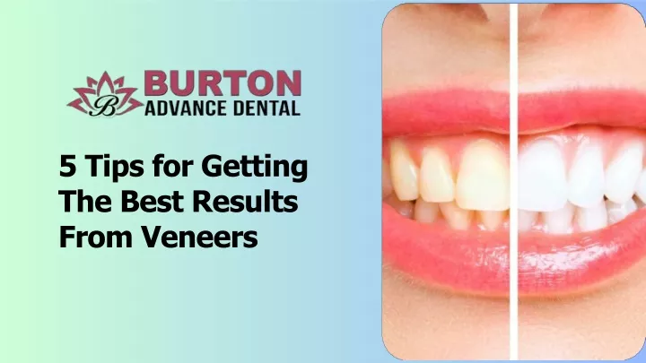 5 tips for getting the best results f rom veneers