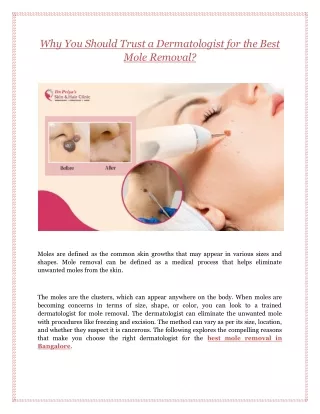 Why You Should Trust a Dermatologist for the Best Mole Removal?