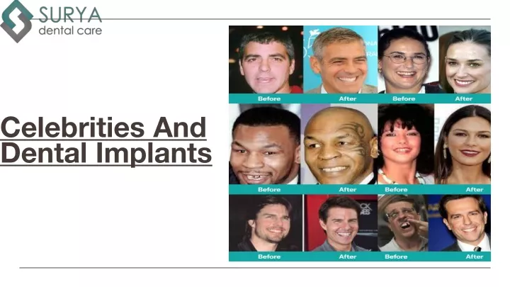 celebrities and dental implants